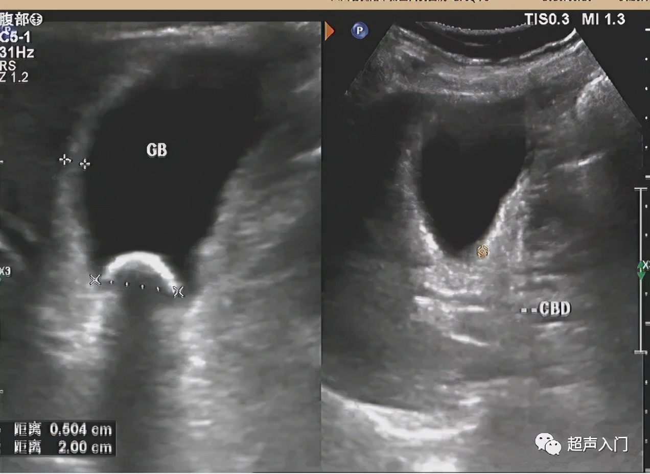 急性胆囊炎超声表现入门教学视频,急性胆囊炎超声诊断怎么写