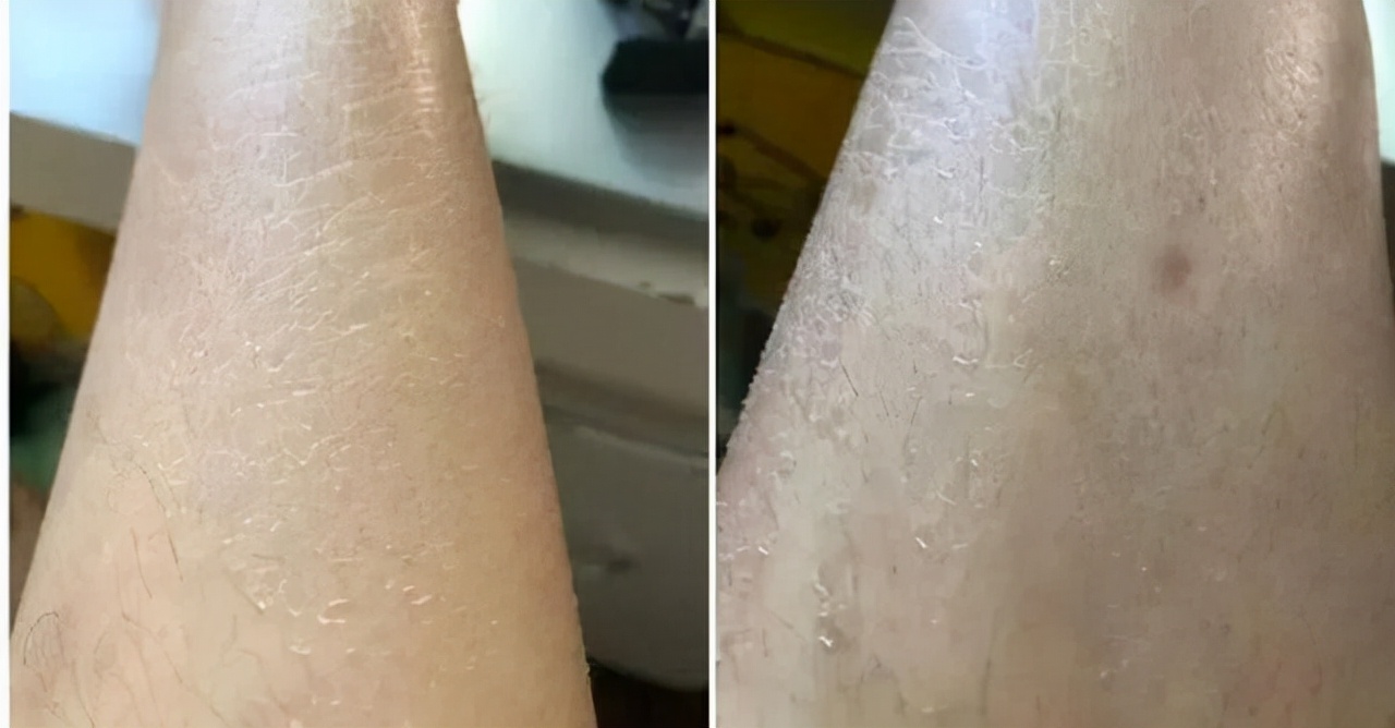 皮肤为什么会变干变硬,干燥的皮肤怎样变得水润