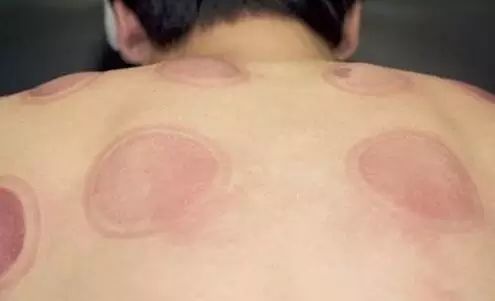 一看就会手把手教拔罐疗法,学拔罐视频教程全集