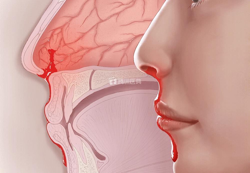 娃一天流3次鼻血,用纸巾堵住后竟吐血!这些止血法太坑娃