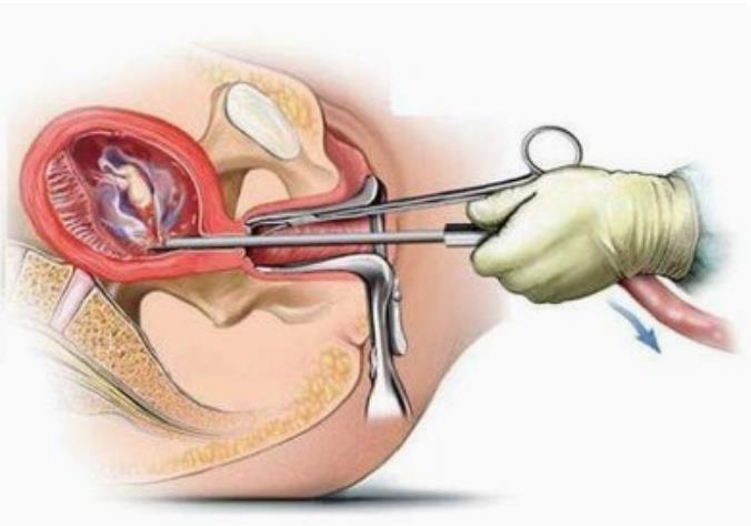 爱护子宫的六种方法,如何预防人工流产的并发症