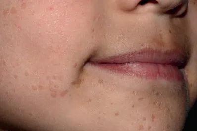 脸上长了闭口小颗粒怎么去除,脸上长白色小颗粒怎样去除掉