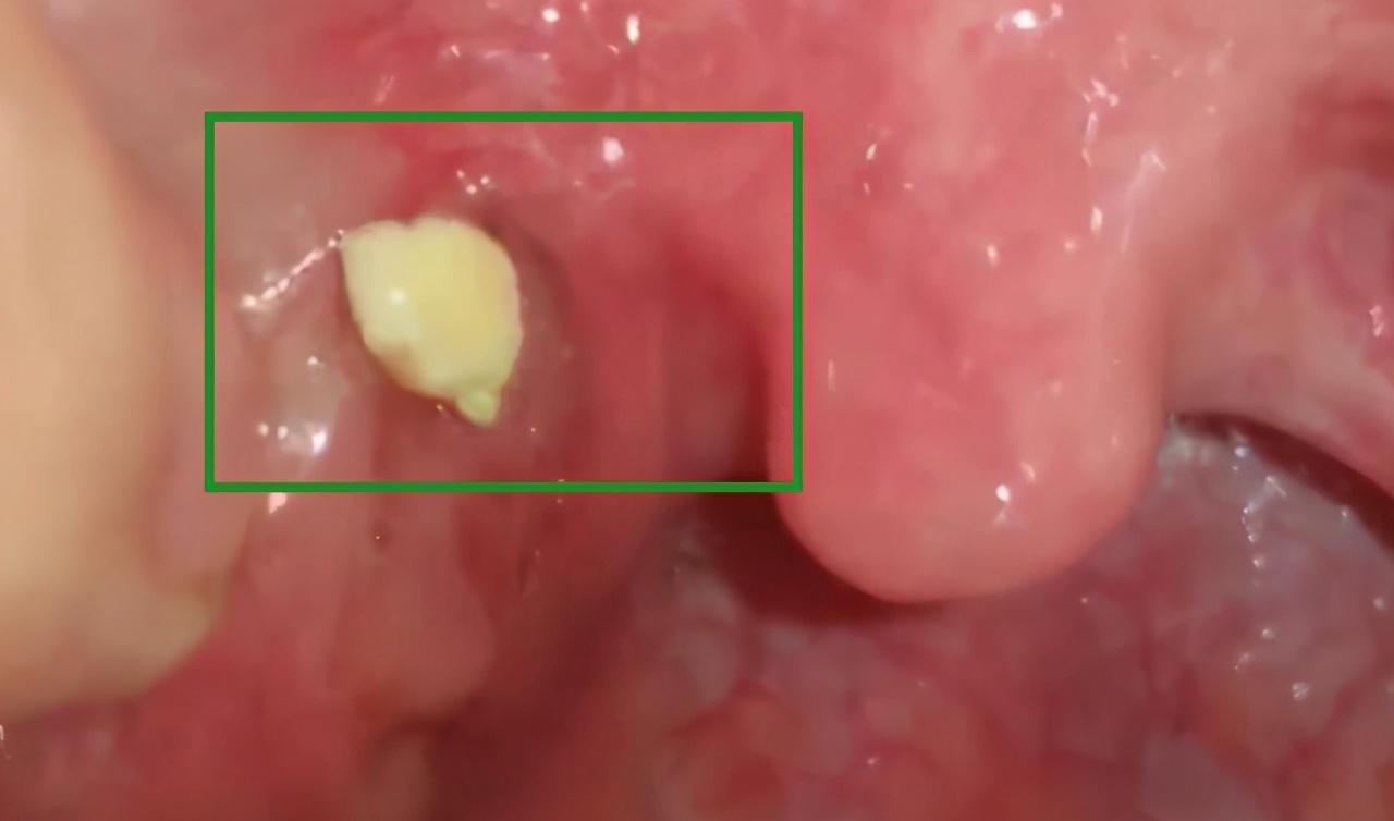 咳出扁桃体结石说明了什么,咳出来的扁桃体结石好臭