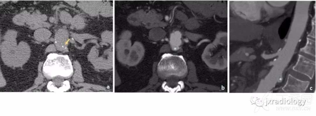 急性主动脉综合征报道,急性主动脉综合征症状