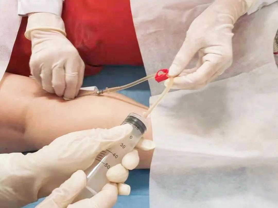 腘窝囊肿内引流术,我院完成首例上颌骨囊肿切除手术