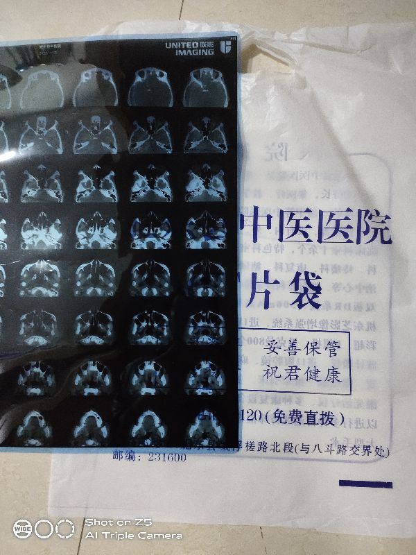 拔牙时发现牙根有个脓包,拔牙拍片发现上颌有个囊肿