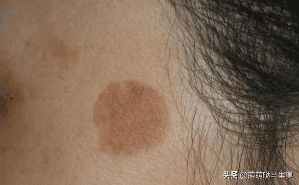 维生素e怎样用去皱纹,维生素e怎样用才达到淡斑的作用