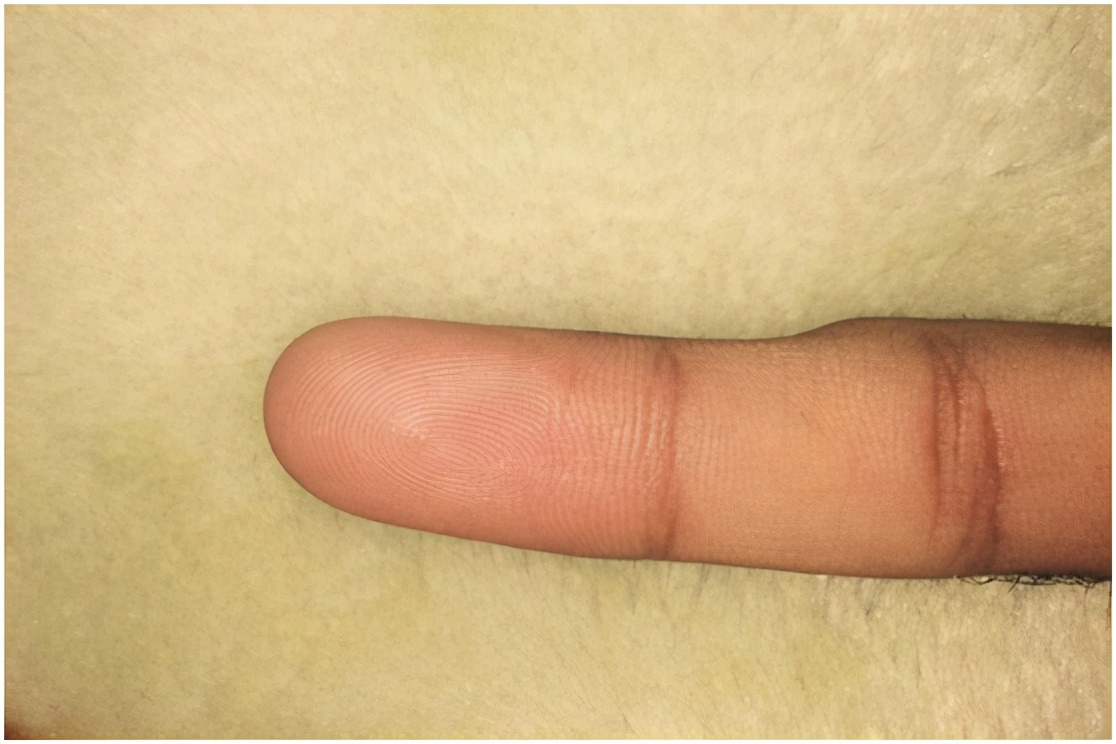 经常玩手机小拇指都弯了,长期玩手机小拇指弯曲是怎么回事