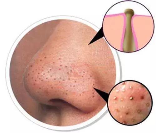 你知道黑头是怎么形成的吗,怎么分辨黑头的严重程度