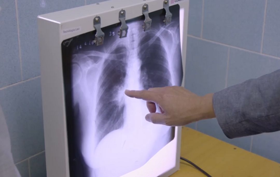 新型肺癌疫苗有望攻克,对抗癌症的疫苗