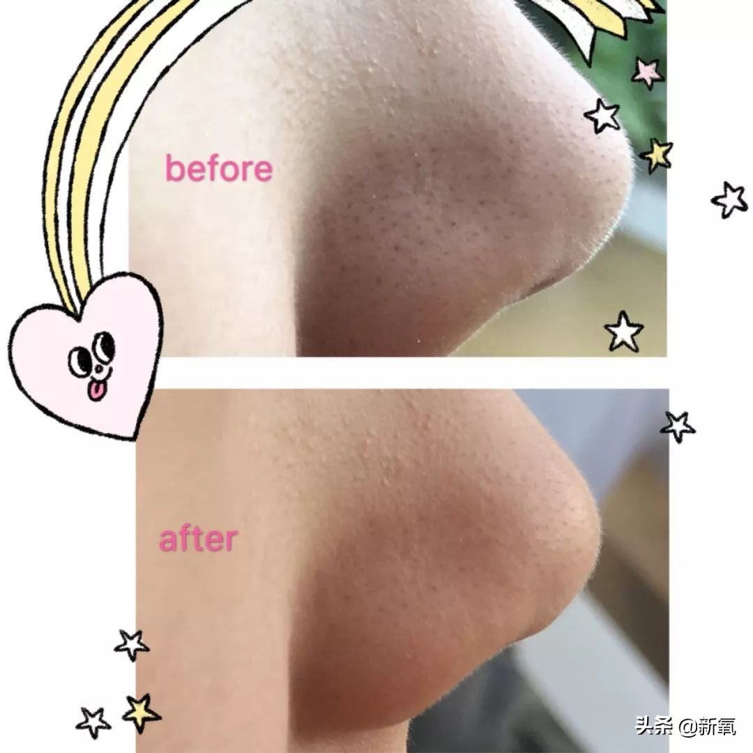 去黑头最有效的方法一个月见效,别挤了教你去黑头的正确方法