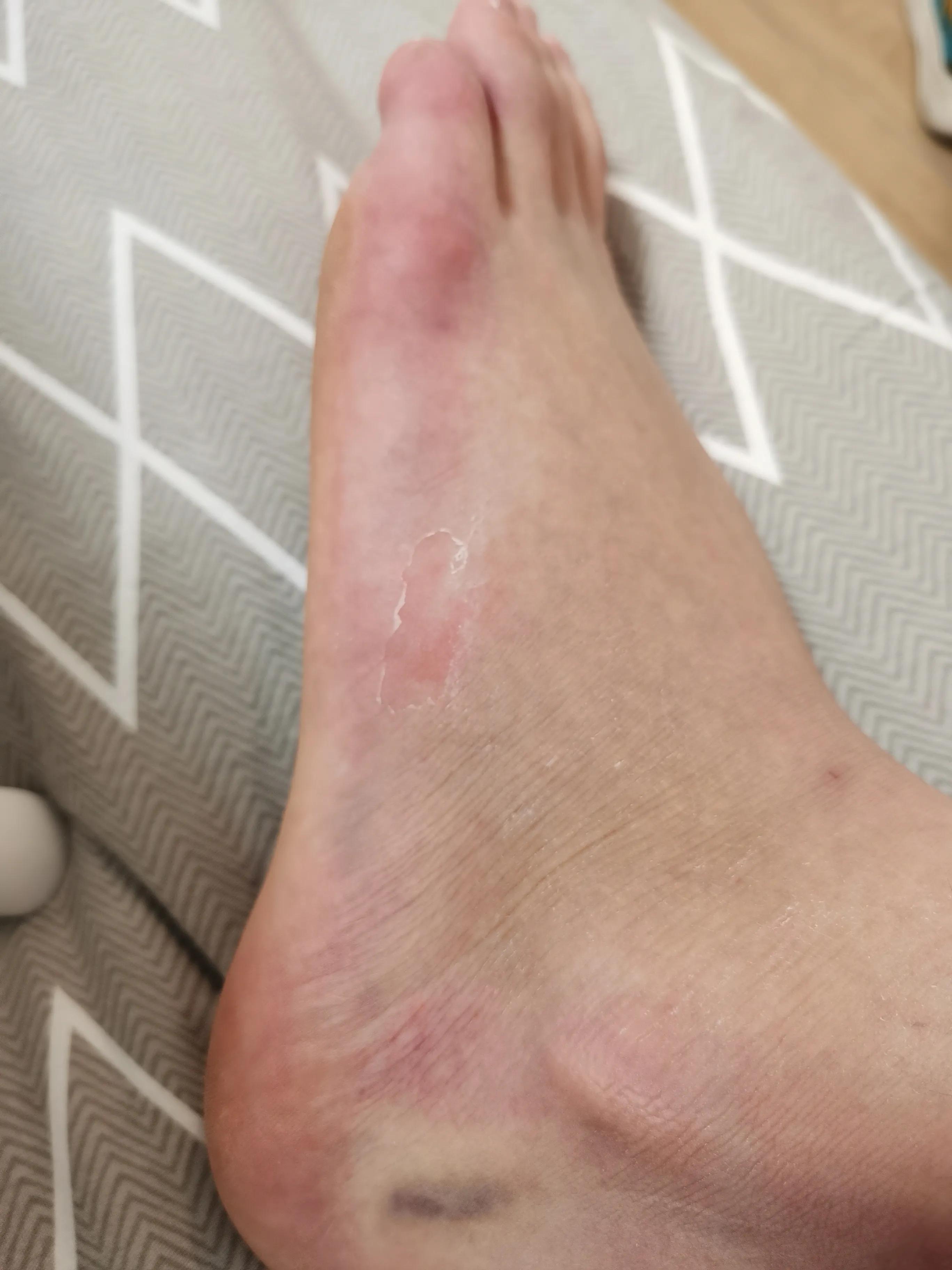 第五跖骨粉碎性骨折多久后能走路,第五跖骨基底骨折100天了走路肿