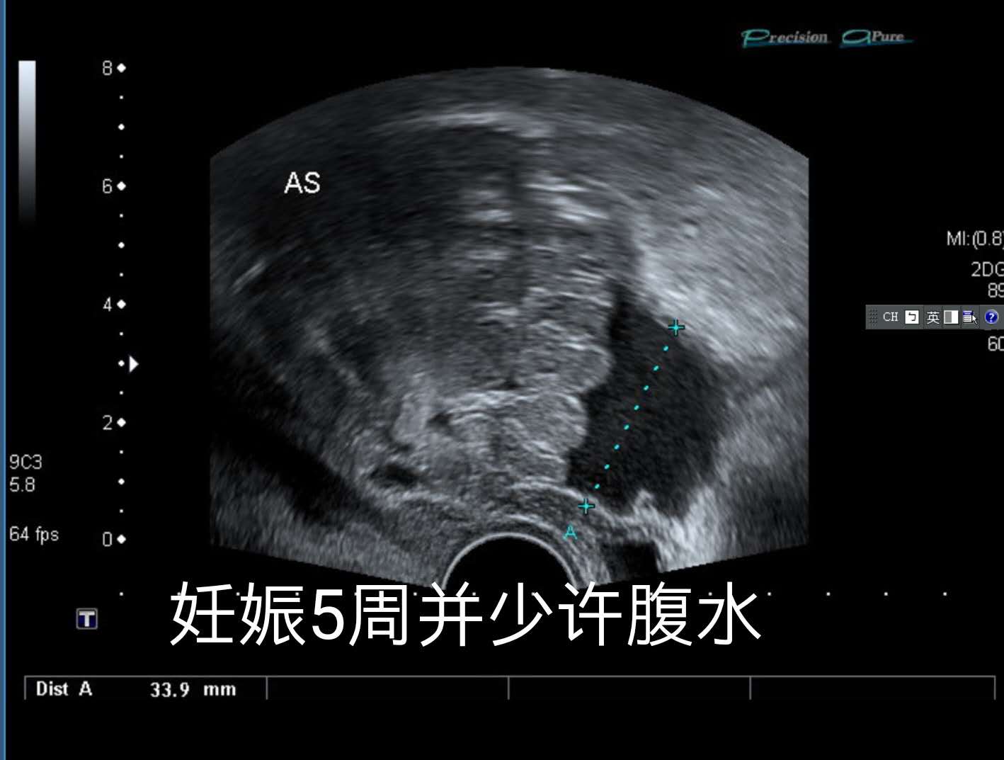 双胞胎一个宫内一个宫外大出血,双胞胎一个流产一个宫外孕