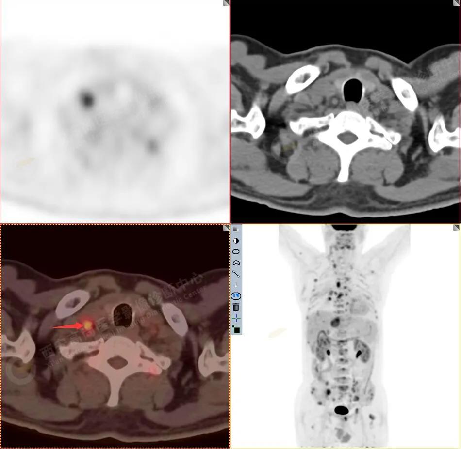 petct检查报告肺结节考虑恶性肿瘤,30mm肺结节pet显示没有转移