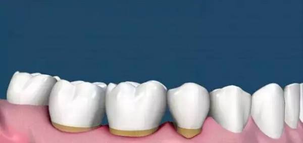 洗牙到底怎么洗好,洗牙洗的不干净