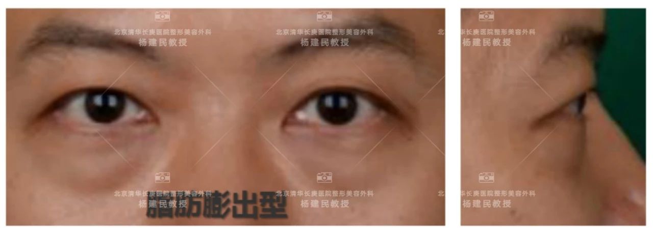 如何分清自己是哪种类型的眼袋,怎么看是哪种类型的眼袋