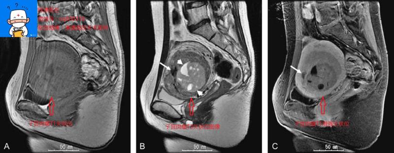 子宫内膜肌瘤鉴别诊断,子宫肌瘤的鉴别诊断以及鉴别要点