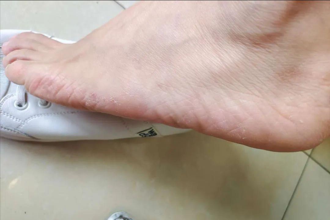 你以为的脚气还不是脚气