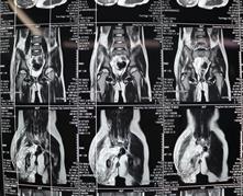 淋巴血管畸形治疗费用,淋巴静脉畸形治疗