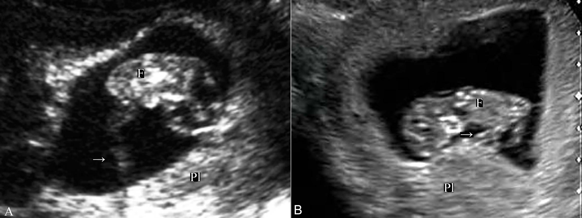 一级超声检查能检查出脐带绕颈吗,脐带超声检查图解