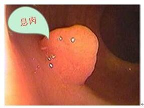 肛门息肉能引起哪些症状,直肠息肉会引起肛门啥症状