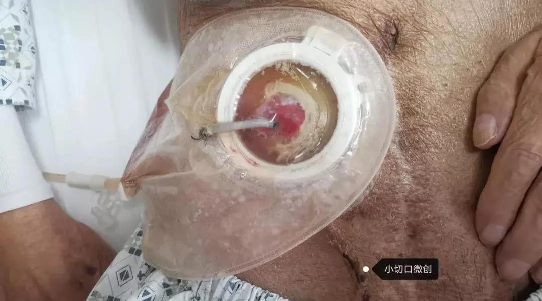 “大爷,你的肠子怎么老往外掉?”