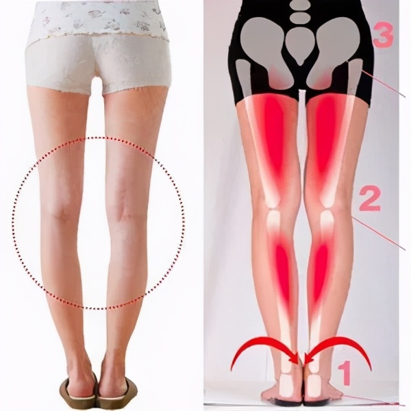 小腿外翻如何把腿练直,小腿外翻腿不直怎么矫正训练