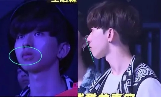 蔡徐坤整牙前后对比图片,蔡徐坤整牙前图片