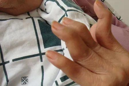 类风湿性关节炎被称为不死的癌症,类风湿为何称不死的癌症