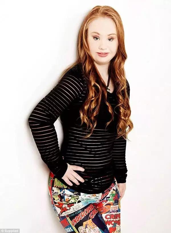 唐氏综合征中国美女,患有唐氏综合征的维密模特