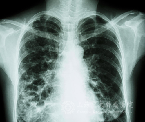 肺癌晚期胸腔积液气喘脚肿怎么办,肺癌晚期胸腔积液脑转移能活多久