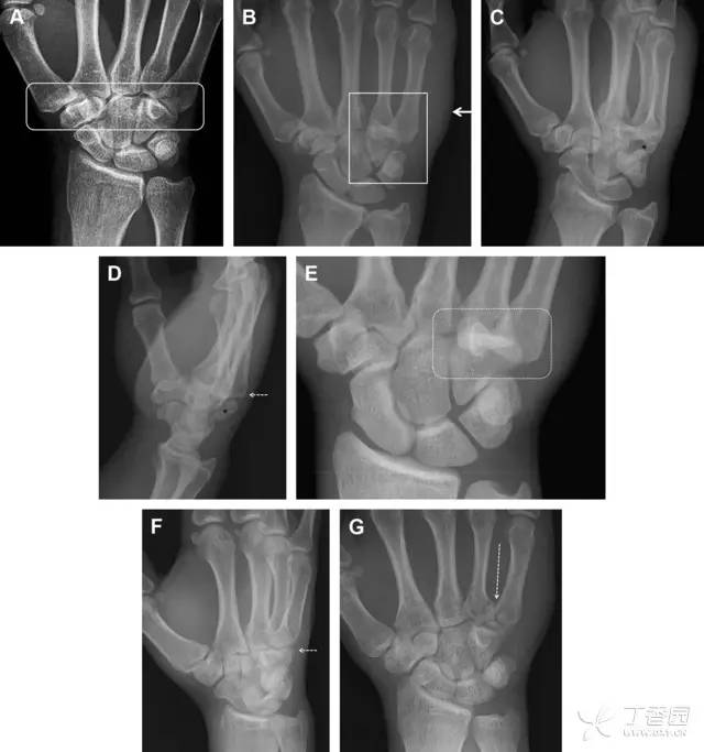 常见的八种骨折,容易漏诊的肩关节骨折