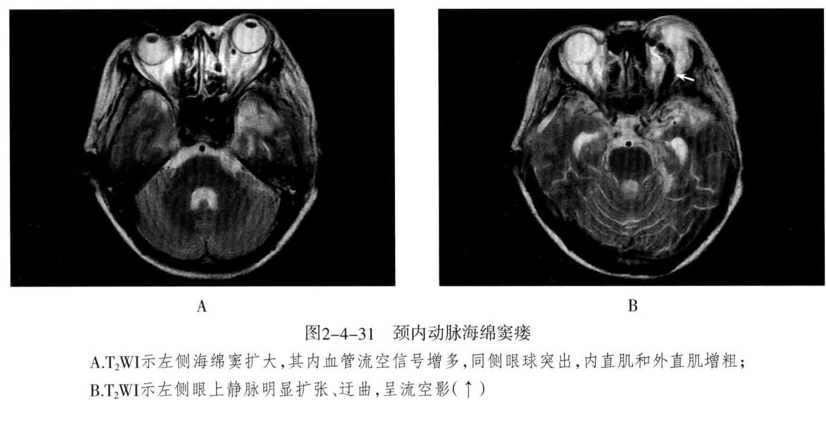 颅内血管轻度狭窄诊断标准,颅内血管先天变异影像