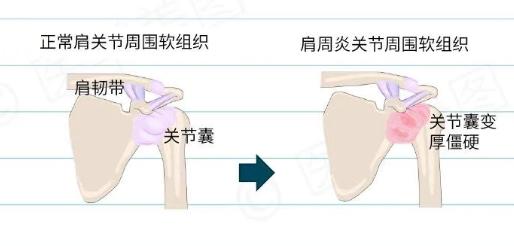 肩周炎为什么难治疗,肩周炎为什么总治不好