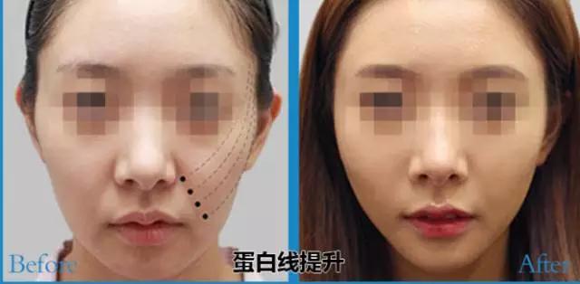 什么是线雕美容过程,什么是线雕眉