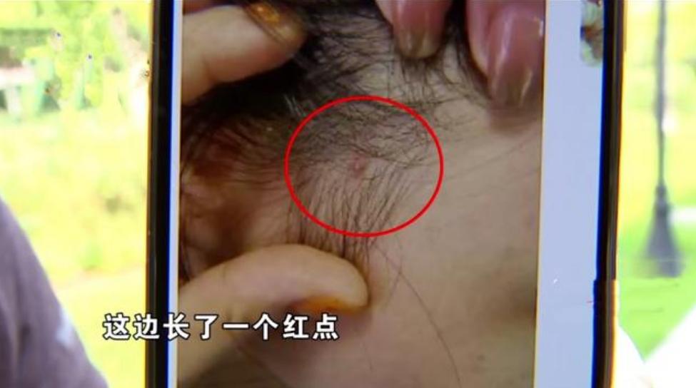 做完面部线雕有后遗症如何维权,做线雕毁容留下后遗症怎样打官司