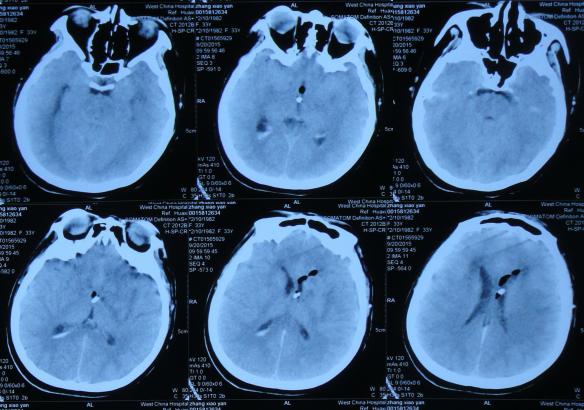 结核性脑积水,脑膜炎脑积水要治疗多久