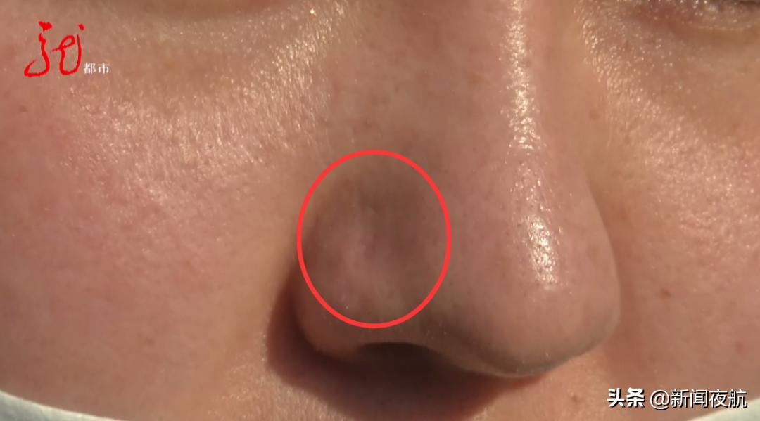 做完小气泡后鼻子肿了什么情况,做完小气泡鼻子肿大