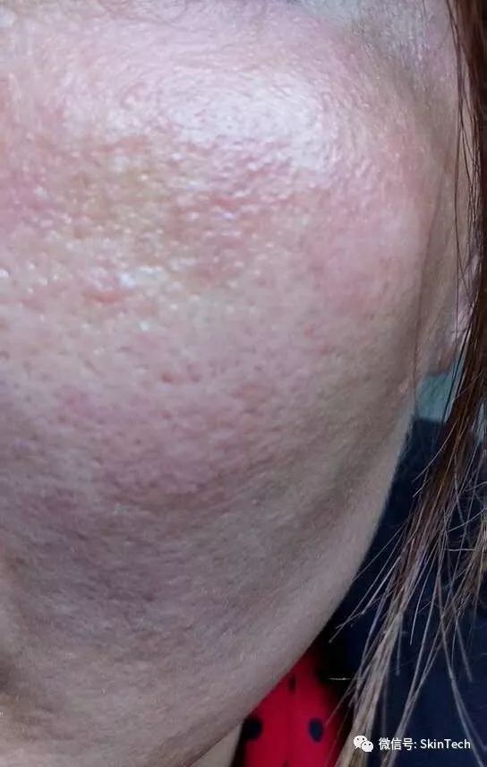 辟谣逆光疹,逆光疹是伪概念吗