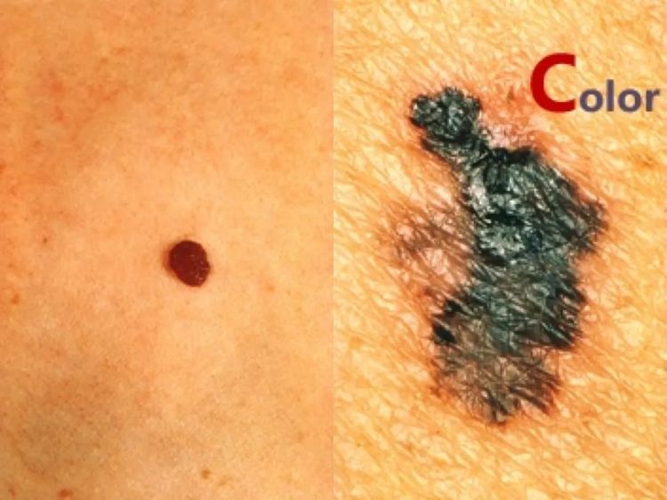 激光点痣不小心照了紫灯怎么办,切除黑色素痣可能癌变吗