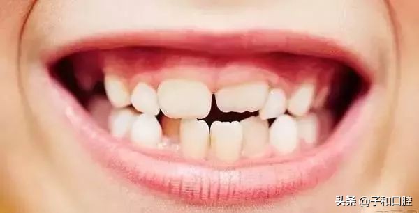 孩子牙齿都烂没了影响换牙吗,孩子牙齿坏了觉得自己不配做父母