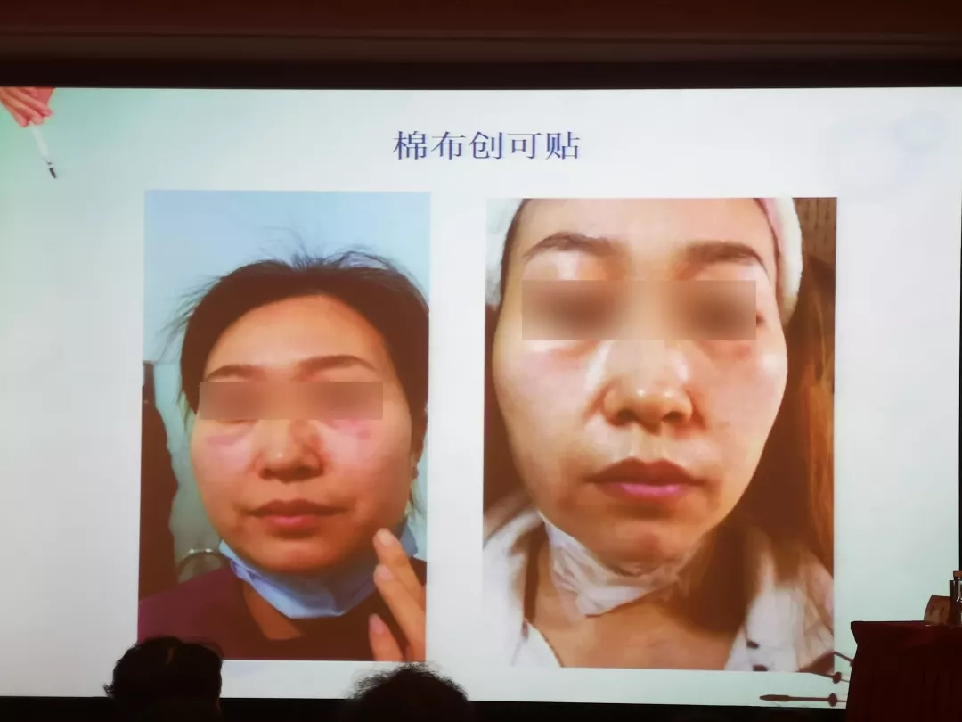 上海九院修复因子,上海九院整形科皮秒祛斑