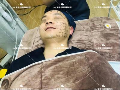 第一次做热玛吉的感受,热玛吉术后注意事项和护理