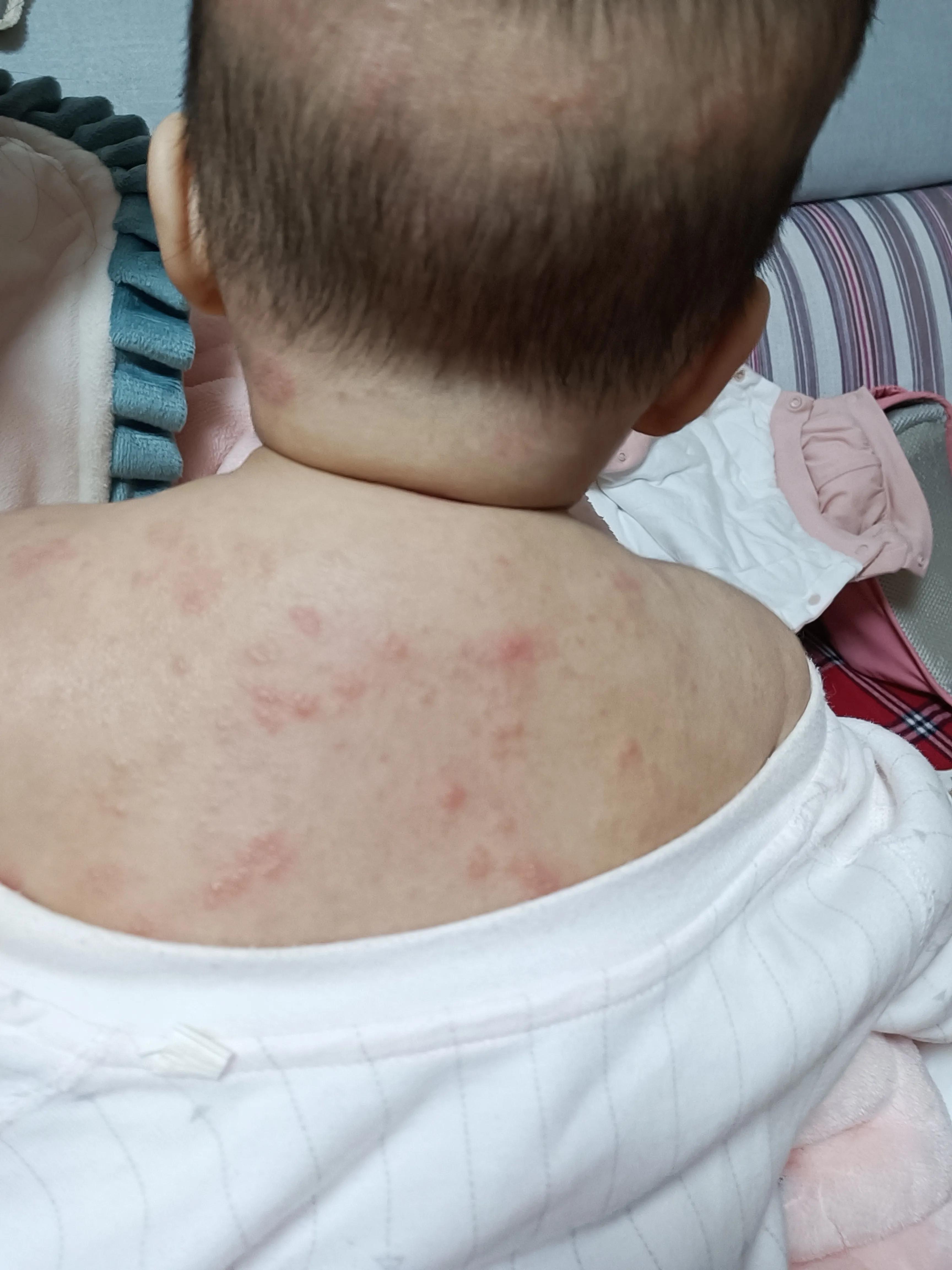 婴儿湿疹治疗心路,宝宝湿疹攻略