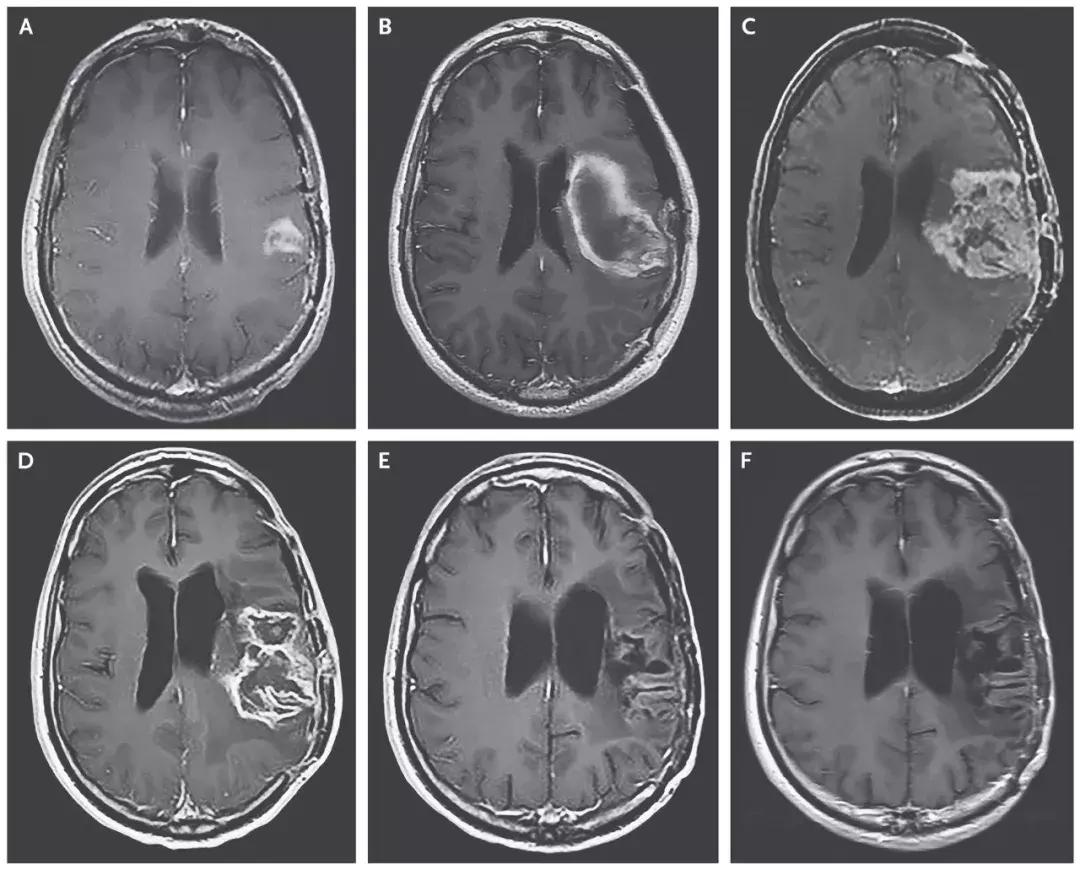 2019抗癌治疗,5分钟全面了解癌症的免疫治疗
