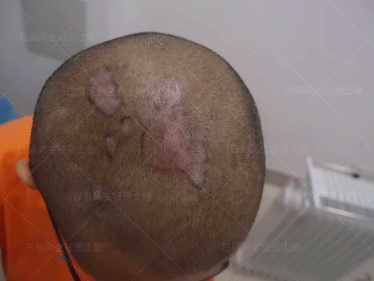 好多人说白癜风治不好,手指上白癜风治好的案例