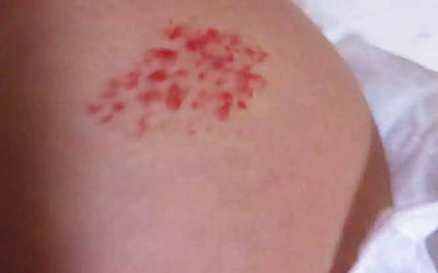 百天宝宝患有血管瘤，激光、敷药该如何抉择？愁坏妈妈