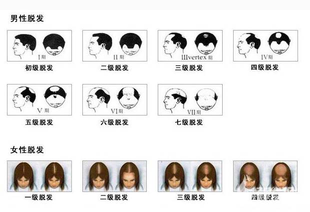 头顶后脑勺大面积脱发还能植发吗,男士大面积植发7个月