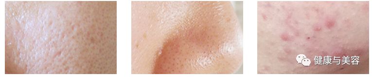 哪种产品可以治疗痘痘,青春痘十大救星