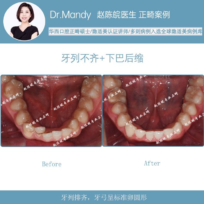 杭州牙齿隐形矫正,杭州成人隐形矫正牙齿优惠